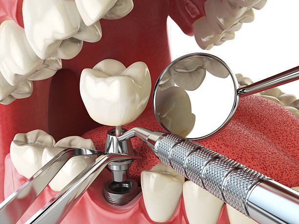 Best Emergency Root Canal Treatment in Sharon, MS